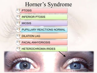 Horner’s Syndrome
PTOSIS
INFERIOR PTOSIS
MIOSIS
PUPILLARY REACTIONS NORMAL
DILATION LAG
FACIAL ANHYDRIOSIS
HETEROCHROMIA IRIDES
 