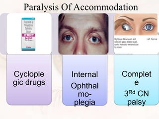 Paralysis Of Accommodation
Cyclople
gic drugs
Internal
Ophthal
mo-
plegia
Complet
e
3Rd CN
palsy
 