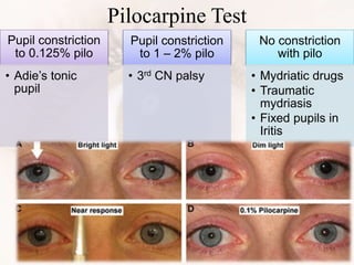 Pilocarpine Test
Pupil constriction
to 0.125% pilo
• Adie’s tonic
pupil
Pupil constriction
to 1 – 2% pilo
• 3rd CN palsy
No constriction
with pilo
• Mydriatic drugs
• Traumatic
mydriasis
• Fixed pupils in
Iritis
 