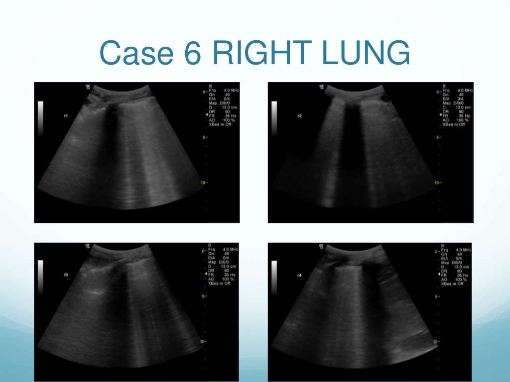 Lung Ultrasound Final Quiz