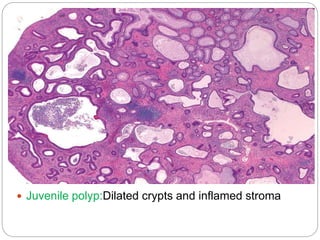 Recent advances in colorectal carcinoma | PPTX