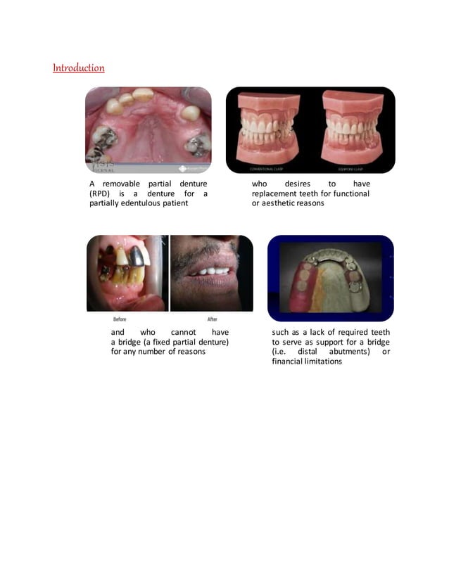 Materials used in Removable Partial Denture