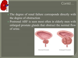  The degree of renal failure corresponds directly with
the degree of obstruction
 Postrenal ARF is seen most often in elderly men with
enlarged prostate glands that obstruct the normal flow
of urine.
 