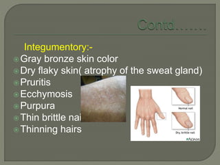 Integumentory:-
Gray bronze skin color
Dry flaky skin( atrophy of the sweat gland)
Pruritis
Ecchymosis
Purpura
Thin brittle nails
Thinning hairs
 