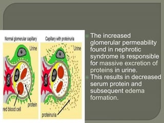  The increased
glomerular permeability
found in nephrotic
syndrome is responsible
for massive excretion of
proteins in urine.
 This results in decreased
serum protein and
subsequent edema
formation.
 