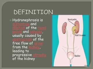  Hydronephrosis is
distention and
dilation of the renal
pelvis and calyces,
usually caused by
obstruction of the
free flow of urine
from the kidney,
leading to
progressive atrophy
of the kidney
 