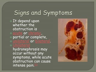  It depend upon
whether the
obstruction is
 acute or chronic,
 partial or complete,
 unilateral or bilateral.
 Unilateral
hydronephrosis may
occur without any
symptoms, while acute
obstruction can cause
intense pain.[1]
 
