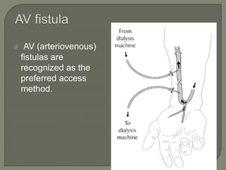  AV (arteriovenous)
fistulas are
recognized as the
preferred access
method.
 