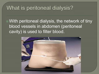 With peritoneal dialysis, the network of tiny
blood vessels in abdomen (peritoneal
cavity) is used to filter blood.
 
