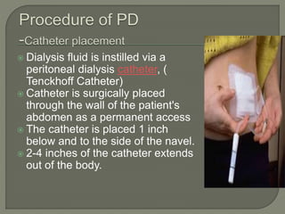  Dialysis fluid is instilled via a
peritoneal dialysis catheter, (
Tenckhoff Catheter)
 Catheter is surgically placed
through the wall of the patient's
abdomen as a permanent access
 The catheter is placed 1 inch
below and to the side of the navel.
 2-4 inches of the catheter extends
out of the body.
 