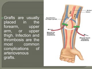 Grafts are usually
placed in the
forearm, upper
arm, or upper
thigh. Infection and
thrombosis are the
most common
complications of
arteriovenous
grafts.
 