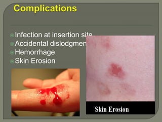 Infection at insertion site.
Accidental dislodgment
Hemorrhage
Skin Erosion
 