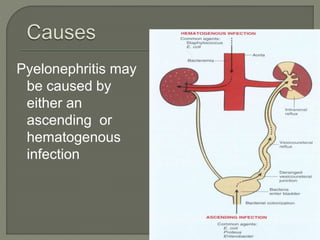 Pyelonephritis may
be caused by
either an
ascending or
hematogenous
infection
 