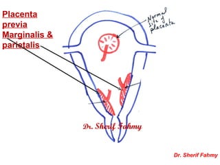 Placenta
previa
Marginalis &
parietalis
Dr. Sherif Fahmy
Dr. Sherif Fahmy
 