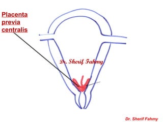 Placenta
previa
centralis
Dr. Sherif Fahmy
Dr. Sherif Fahmy
 