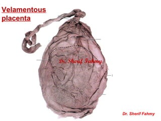 Velamentous
placenta
Dr. Sherif Fahmy
Dr. Sherif Fahmy
 