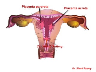 Placenta acreta
Placenta percreta
Dr. Sherif Fahmy
Dr. Sherif Fahmy
 