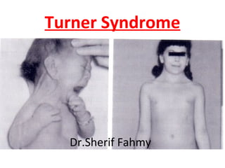 Turner Syndrome
Dr.Sherif Fahmy
 