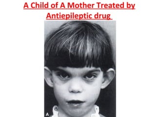 A Child of A Mother Treated by
Antiepileptic drug
 