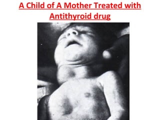 A Child of A Mother Treated with
Antithyroid drug
 