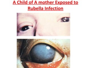 A Child of A mother Exposed to
Rubella Infection
 