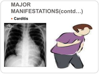 MAJOR
MANIFESTATIONS(contd…)
 Carditis
 