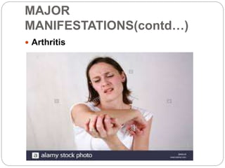 MAJOR
MANIFESTATIONS(contd…)
 Arthritis
 