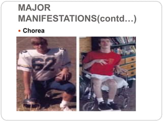 MAJOR
MANIFESTATIONS(contd…)
 Chorea
 