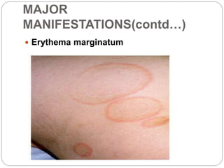 MAJOR
MANIFESTATIONS(contd…)
 Erythema marginatum
 