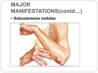 MAJOR
MANIFESTATIONS(contd…)
 Subcutaneous nodules
 