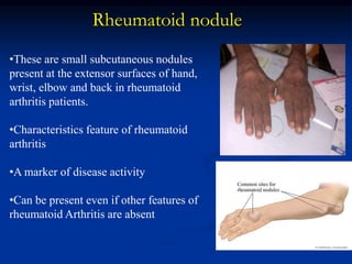 Rheumatoid nodule
•These are small subcutaneous nodules
present at the extensor surfaces of hand,
wrist, elbow and back in rheumatoid
arthritis patients.
•Characteristics feature of rheumatoid
arthritis
•A marker of disease activity
•Can be present even if other features of
rheumatoid Arthritis are absent
 