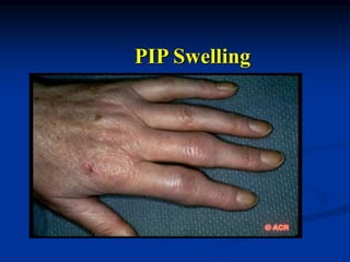 PIP Swelling
 