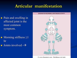 Articular manifestation
 Pain and swelling in
affected joint is the
most common
symptom.
 Morning stiffness ≥1
hr
 Joints involved -
 