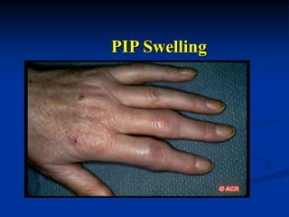 PIP Swelling
 