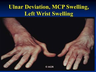 Ulnar Deviation, MCP Swelling,
Left Wrist Swelling
 