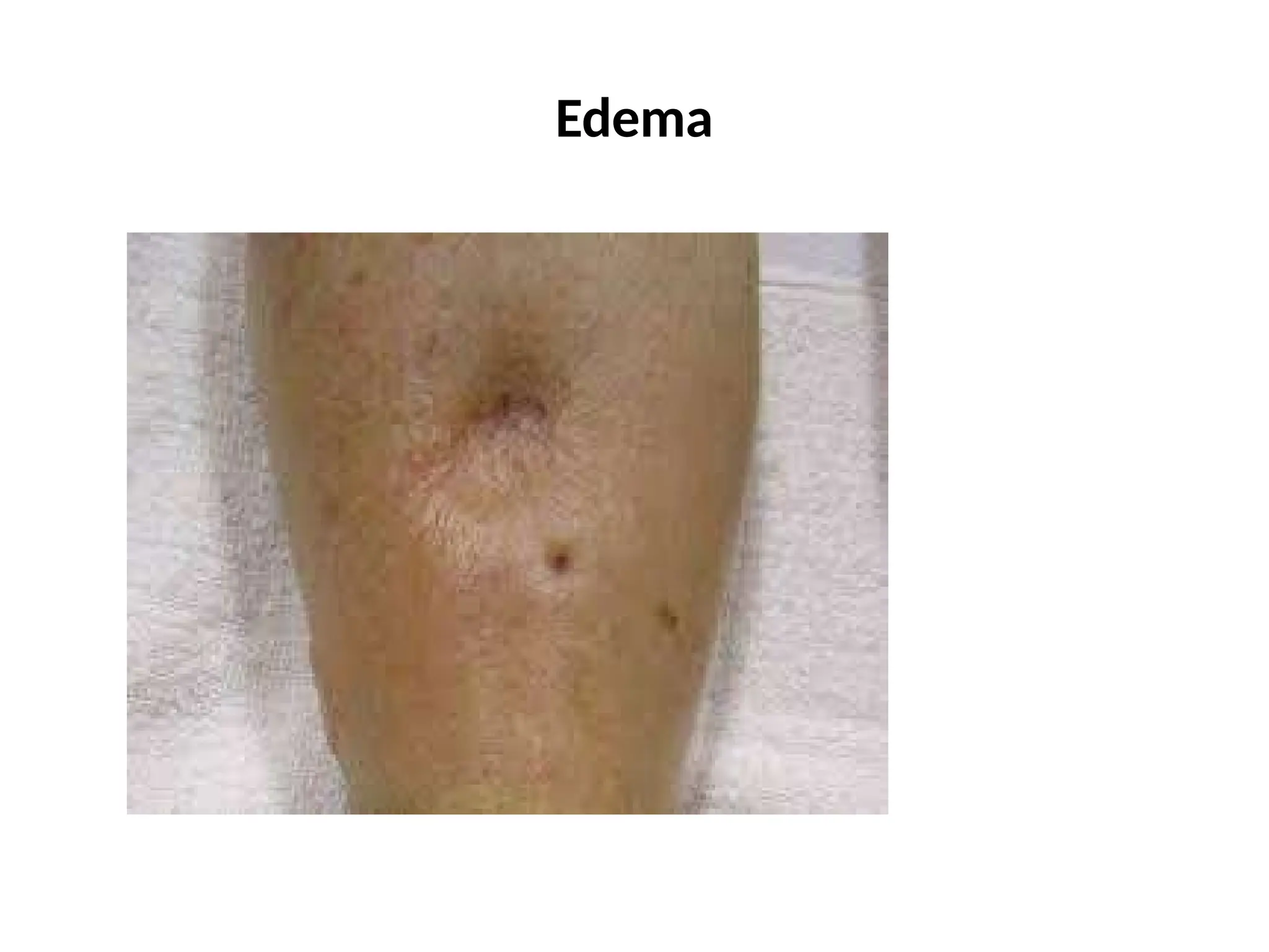 Edema
 