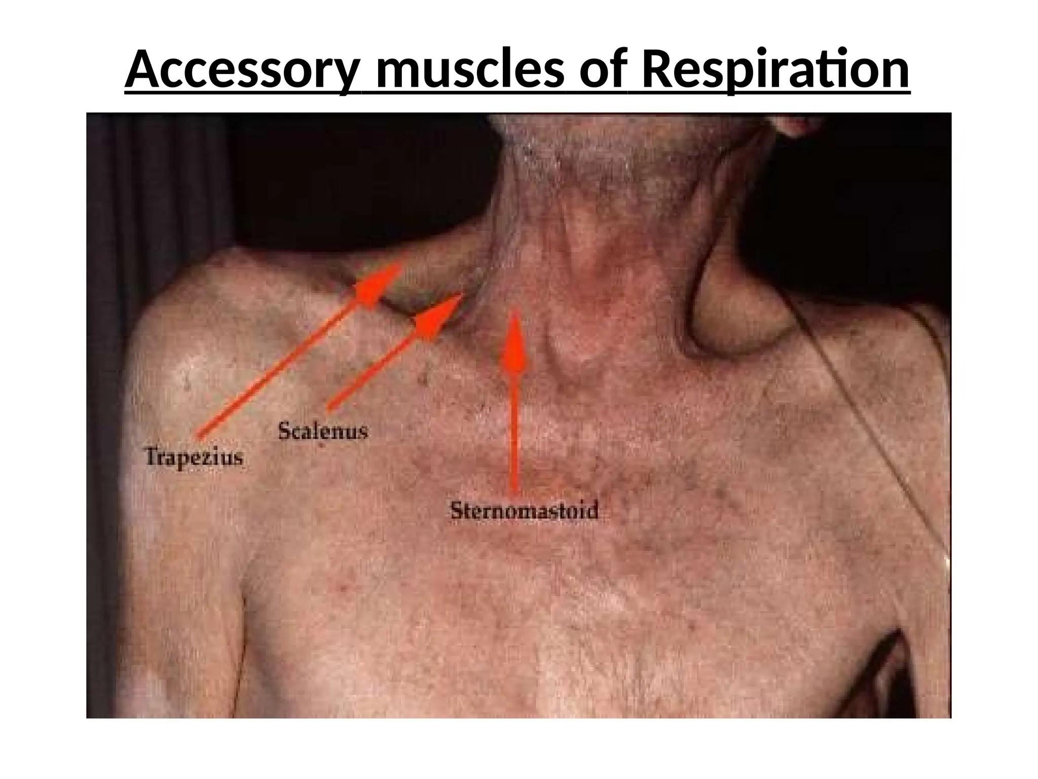 Accessory muscles of Respiration
 