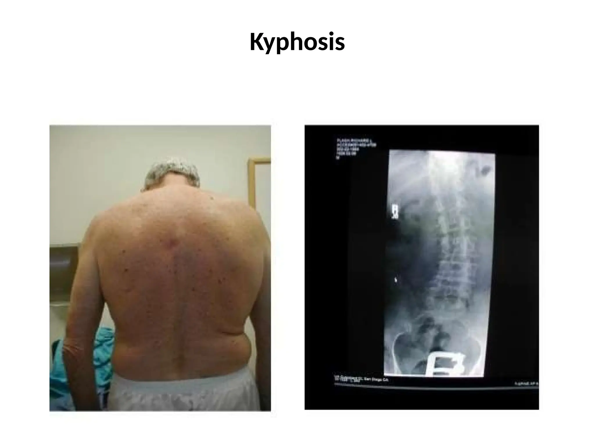 Kyphosis
 