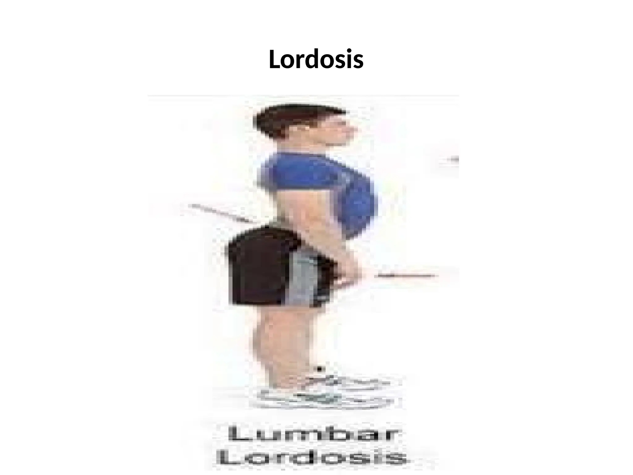 Lordosis
 