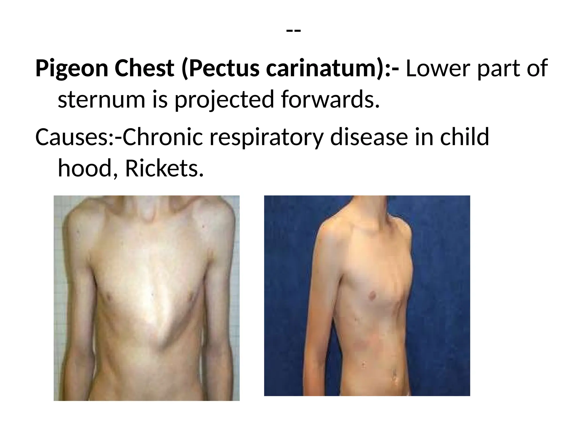 --
Pigeon Chest (Pectus carinatum):- Lower part of
sternum is projected forwards.
Causes:-Chronic respiratory disease in child
hood, Rickets.
 