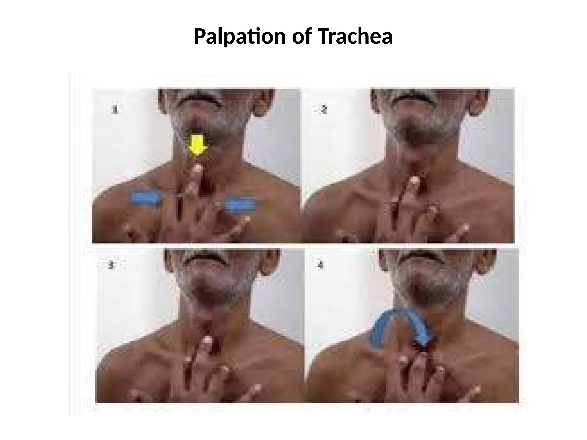 Palpation of Trachea
 