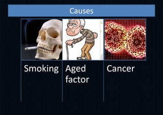 Causes
Smoking Aged
factor
Cancer
 