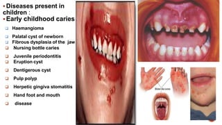  Diseases present in
children :
Early childhood caries
 Haemangioma
 Palatal cyst of newborn
 Fibrous dysplasia of th...