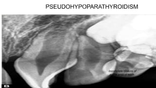 Rh incompatibility - may result in
the condition termed as
‘erythroblastosis fetalis’.
Rh hump on the tooth and
the charac...