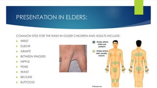 PRESENTATION IN ELDERS:
COMMON SITES FOR THE RASH IN OLDER CHILDREN AND ADULTS INCLUDE:
 WRIST
 ELBOW
 ARMPIT
 BETWEEN FINGERS
 NIPPLE
 PENIS
 WAIST
 BELTLINE
 BUTTOCKS
 
