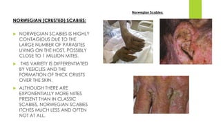 NORWEGIAN (CRUSTED) SCABIES:
 NORWEGIAN SCABIES IS HIGHLY
CONTAGIOUS DUE TO THE
LARGE NUMBER OF PARASITES
LIVING ON THE HOST, POSSIBLY
CLOSE TO 1 MILLION MITES.
 THIS VARIETY IS DIFFERENTIATED
BY VESICLES AND THE
FORMATION OF THICK CRUSTS
OVER THE SKIN.
 ALTHOUGH THERE ARE
EXPONENTIALLY MORE MITES
PRESENT THAN IN CLASSIC
SCABIES, NORWEGIAN SCABIES
ITCHES MUCH LESS AND OFTEN
NOT AT ALL.
Norwegian Scabies:
 