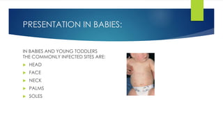 PRESENTATION IN BABIES:
IN BABIES AND YOUNG TODDLERS
THE COMMONLY INFECTED SITES ARE:
 HEAD
 FACE
 NECK
 PALMS
 SOLES
 