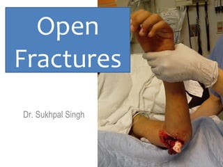 Dr. Sukhpal Singh
Open
Fractures
 