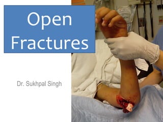 management of open fracture | PPT