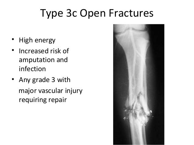 management of open fracture